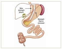 Slider image (4) The Bariatric Group